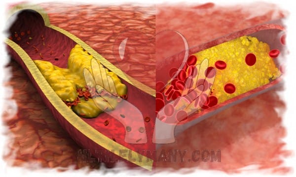 كيفية التعامل مع ارتفاع الكوليسترول والدهون الثلاثية دليل شامل لصحة أفضل 2 كيفية التعامل مع ارتفاع الكوليسترول والدهون الثلاثية